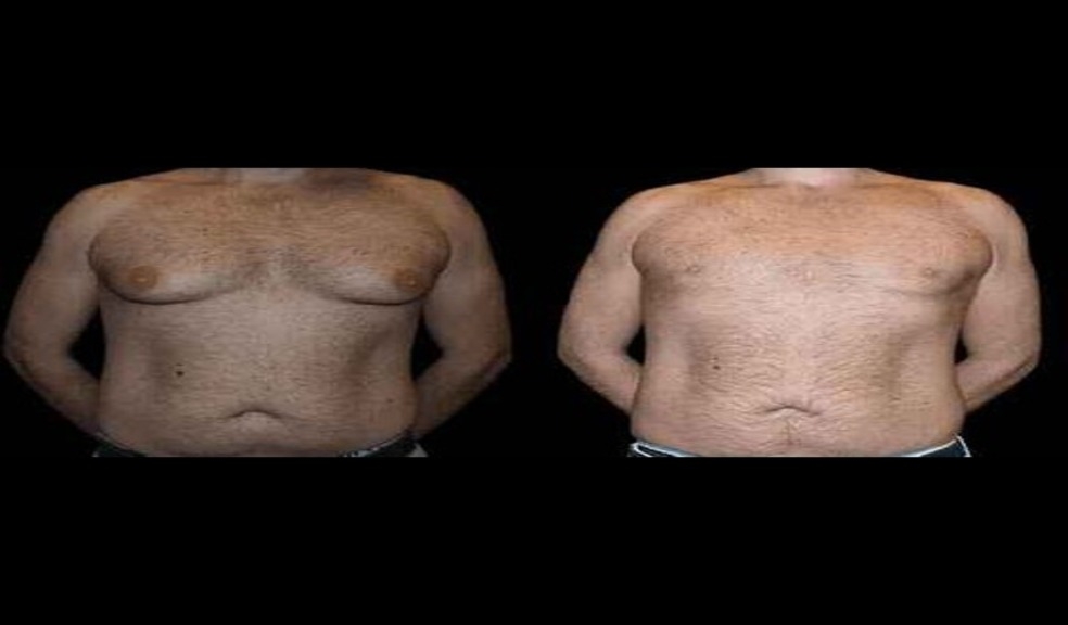 Why Dubai is Home to Some of the World’s Best Gynecomastia Surgeon post thumbnail image